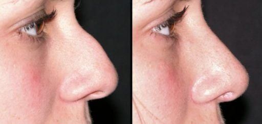 Before and after nasal profile comparison photos.