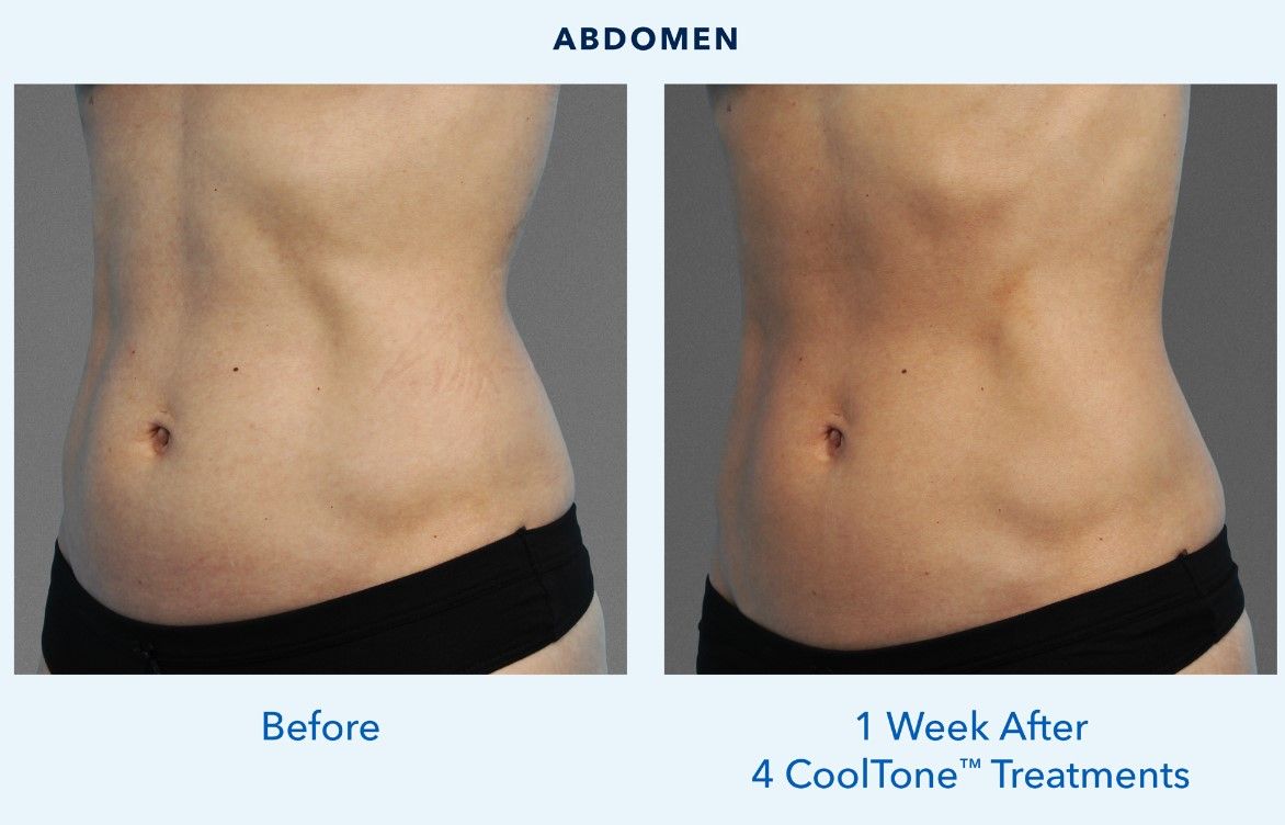 Before and after CoolTone treatments on abdomen.