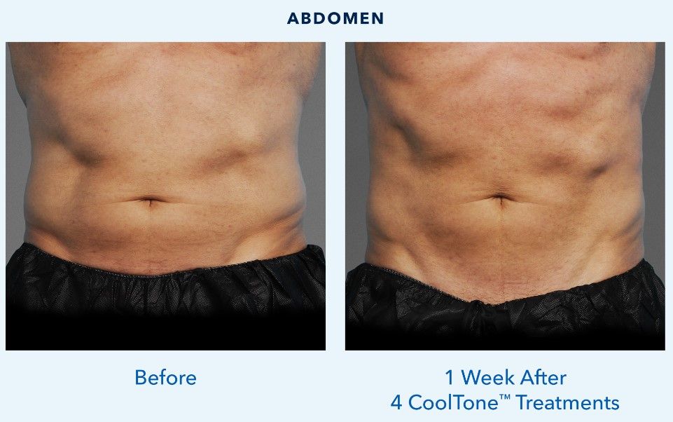 Abdomen before and after CoolTone treatments.