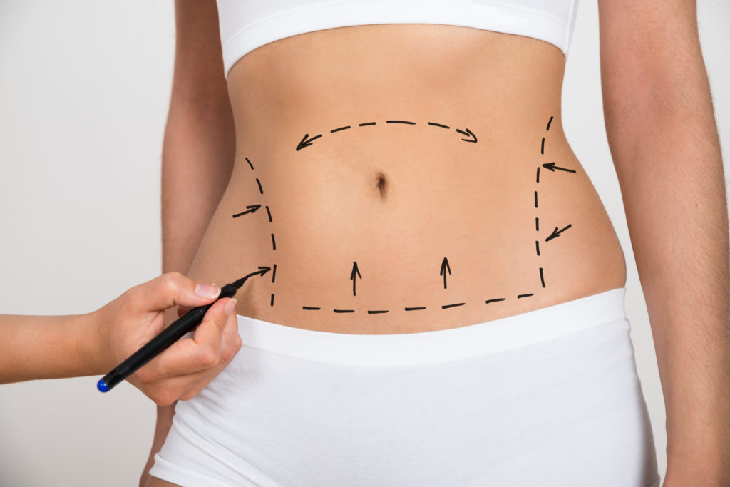 Full Body Liposuction, Abdomen Liposuction Surgery