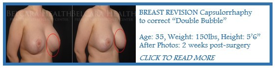 Breast Revision case of the month
