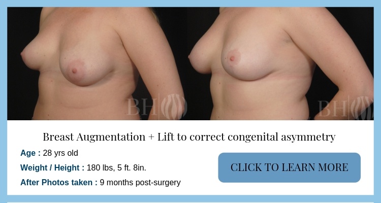 Female patient before and after a breast augmentation & lift